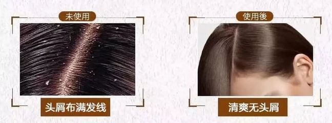 告別脫發(fā)、頭皮屑與頭發(fā)稀少的煩惱，重塑烏黑濃密的秀發(fā)